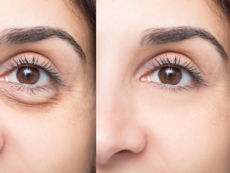 Eye Bag Removal for Brighter, Younger-Looking Eyes
