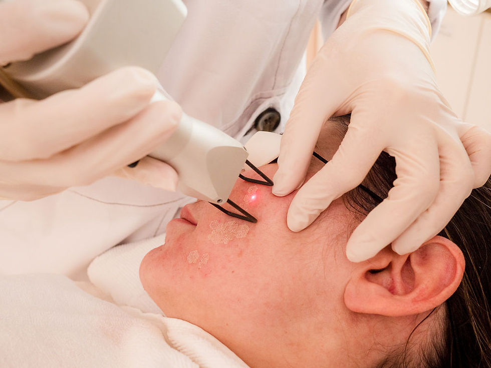 Fractional CO2 Laser Treatment for Reducing Fine Surface Scars