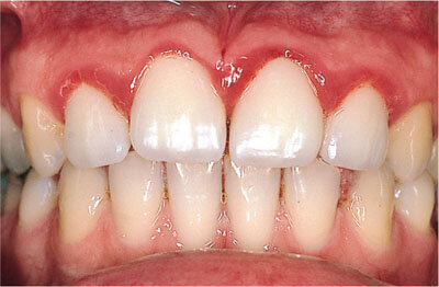 Transform Your Smile with Dental Bridges and Crowns