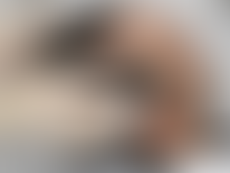 Is Hair Transplant the Cure for Male Pattern Baldness?