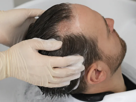 Is Hair Transplant the Cure for Male Pattern Baldness?