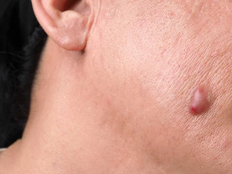 Lipoma Treatment for Quick and Easy Solutions