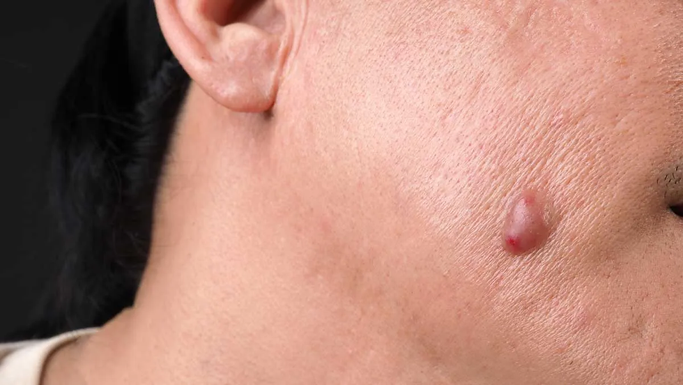 Lipoma Treatment for Quick and Easy Solutions