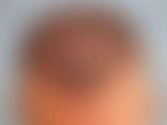 Can Hair Transplant Improve Hair Density Permanently?