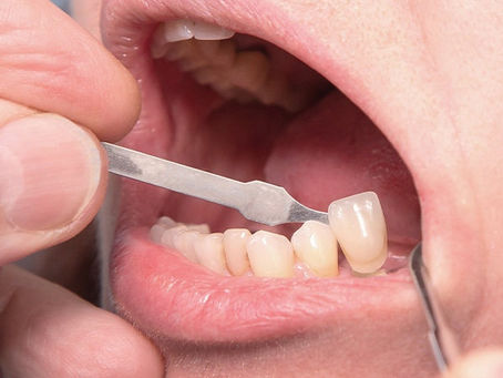 What Is the Recovery Time for Dental Crowns and Bridges?