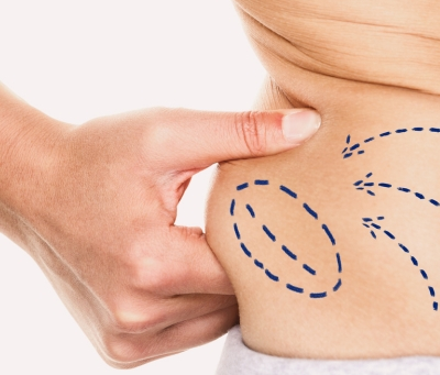 Why Choose Enfield Royal Clinic for Liposuction in Dubai?