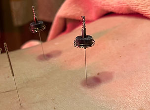 背中に鍼治療、施術について。鍼が皮膚に刺され、赤く腫れている様子。ichihara