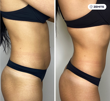 Bridal Body Contouring 4-in-1 inch loss treatments for brides to be Manual Lymphatic Drainage and Visible Results