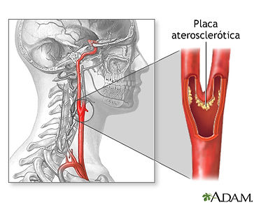 Aterosclerosis carotida.jpg