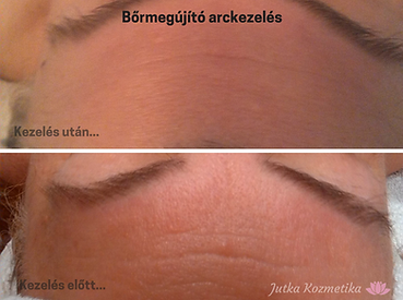 Bőrmegújító arckezelés (1).png
