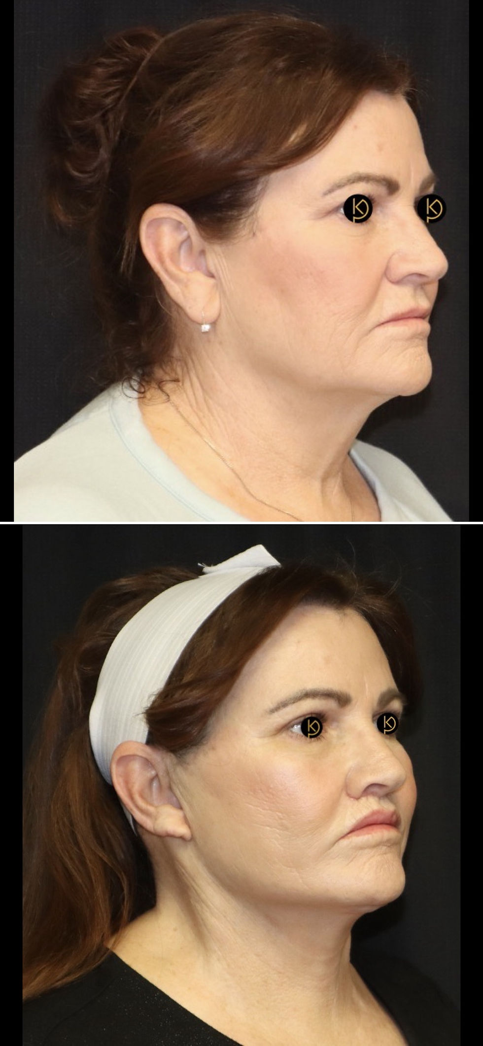 Face lift