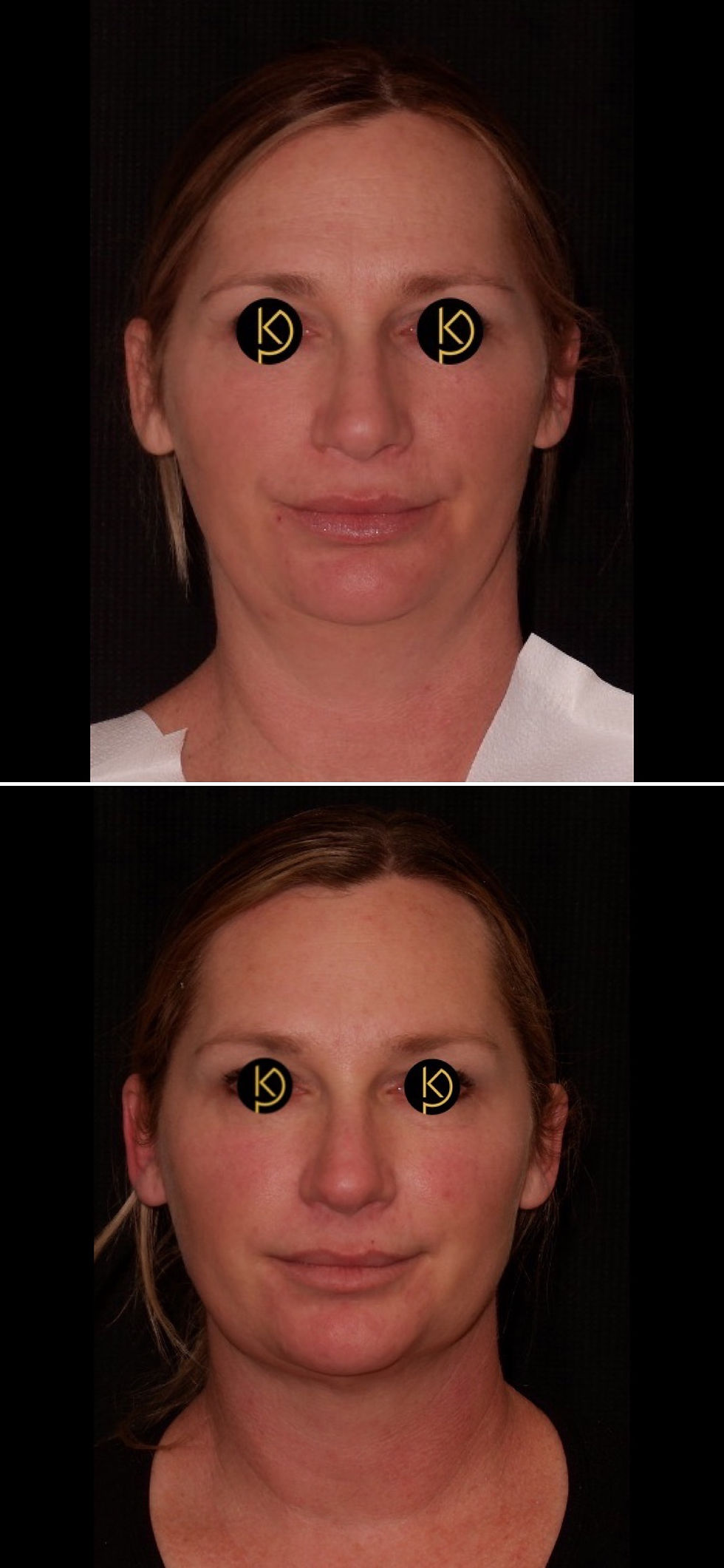 Chin/neck liposuction