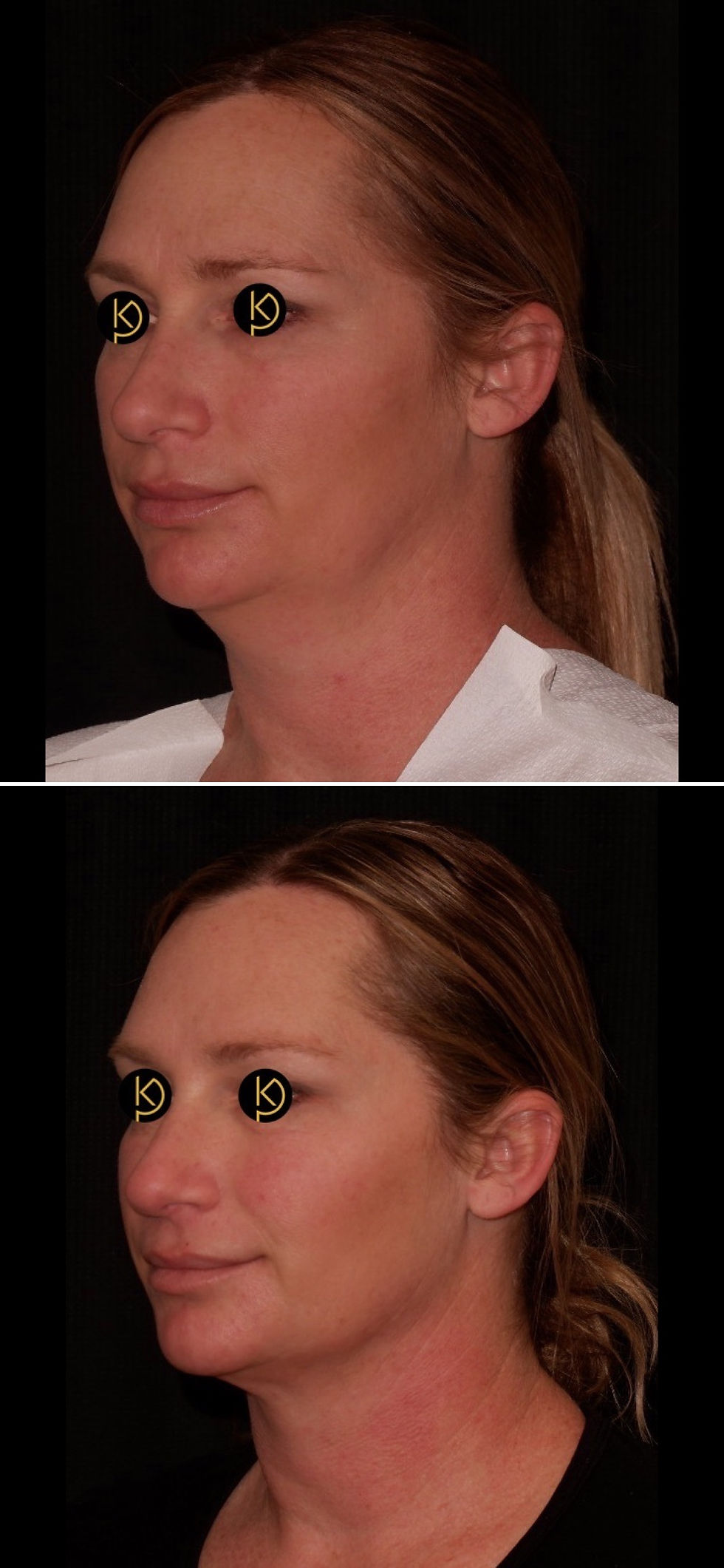 Chin/neck liposuction