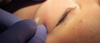 Electrolysis & Hair Removal in Chicago suburbs