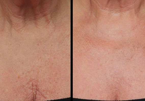 before after profhilo body_edited_edited