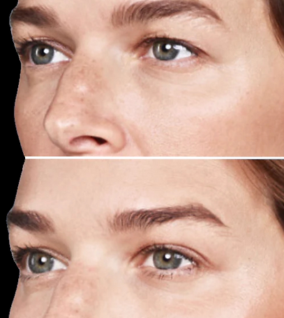 Brow lift_edited_edited_edited.png
