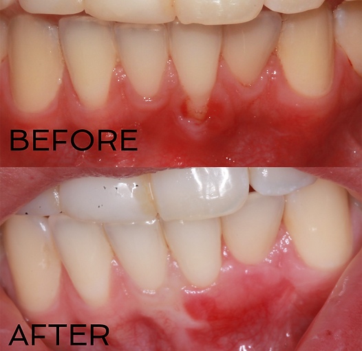 Gingival Recession Before and After