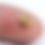 Thumbnail: Kidney stone on fingertip