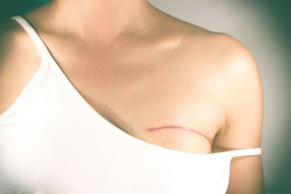 Breast%20cancer%20surgery%20scars%20by%2