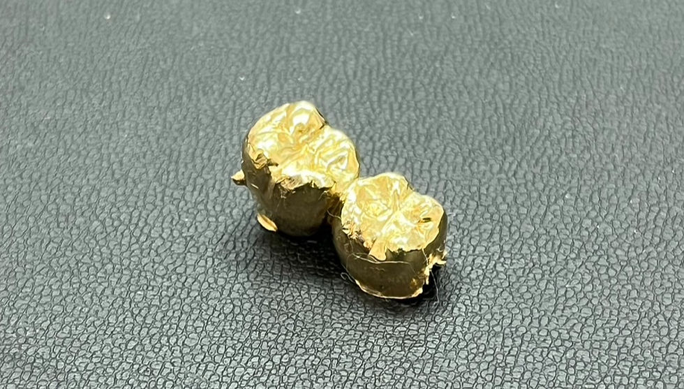 歯医者で取り外した金歯