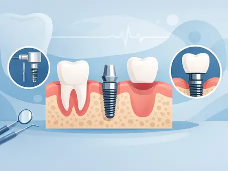 Single Tooth Implant Procedure Explained