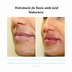 Aumento volumen de labios en Barcelona before and after