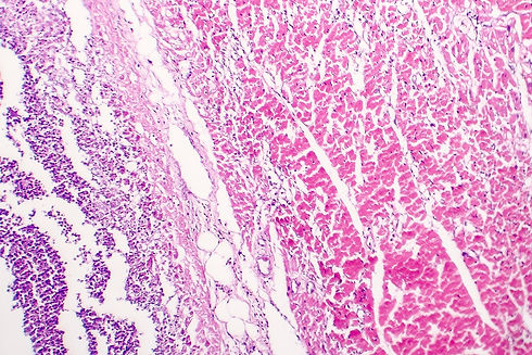 Histopathology of bacterial myocarditis,
