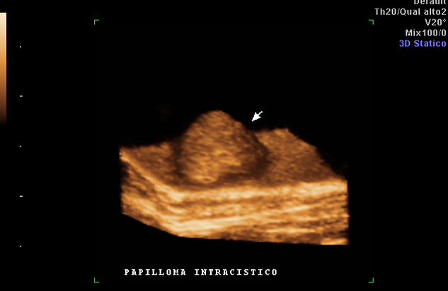 papilloma intracistico mammella)