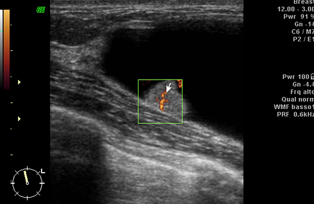 papilloma intraduttale e secrezioni