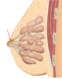 papilloma intraduttale e secrezioni