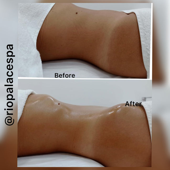 Before and After photos, @riopalacespa, showing stomach massage specials results.