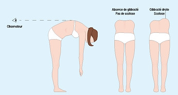 ostéopathie et scoliose