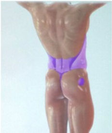 Fettabsaugung VASER Laser BodyTite Fettabbau abnehmen Liposuktion Liposuction Zürich Istanbul
