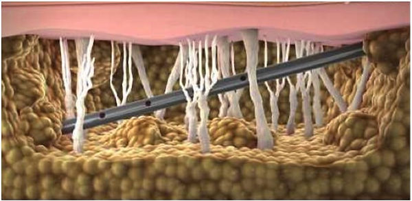 Vaser Laser BodyTite Fettabsaugung Liposuction Liposuktion Istanbul