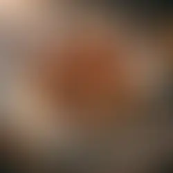 Tarte Fine aux Prunes et Cannelle - maladie de Wilson