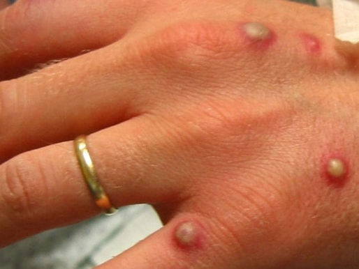 Varíola do Macaco: Minas Gerais investiga primeira morte no mundo