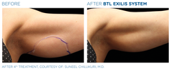 BTL_Exilis_system_PIC_Ba-card-female-arms-016_EN100