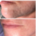 AcneScars_B&A-011.JPG