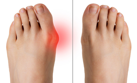 Bunions Treatment in Farnworth and Leeds Area