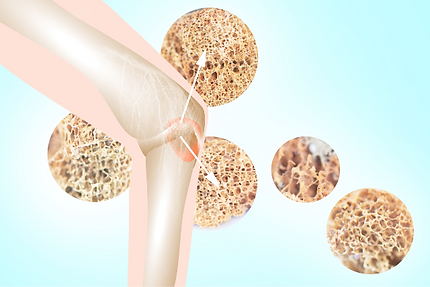 骨密度検査で健康チェック