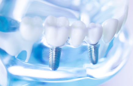 インプラント(自由診療)