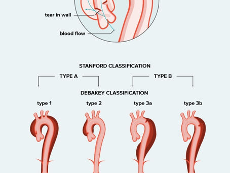 ABCs of an Aortic Dissection