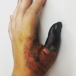 Rattle snake bite!