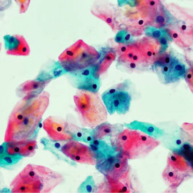 Pap Smears and Trauma: How the Medical System Leaves Sexual Violence Survivors Vulnerable to Cervical Cancer