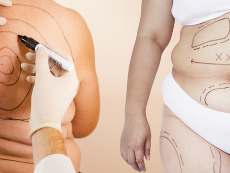 Liposuction: A Complement to Your Weight Loss Journey