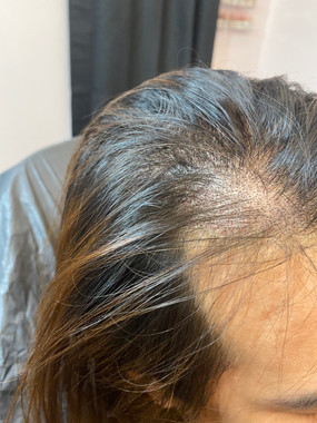 Scalp Micropigmentation