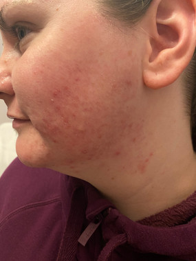 Acne Lift Facial Treatments