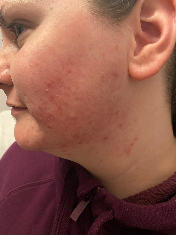 Acne Lift Facial Treatments