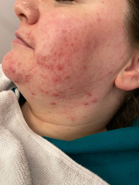 Acne Lift Facial Treatments
