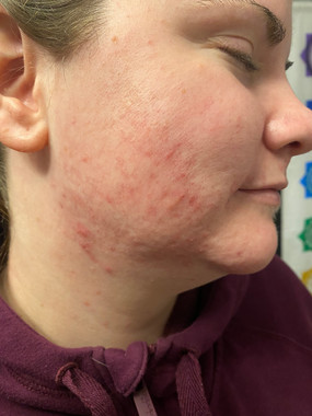 Acne Lift Facial Treatments